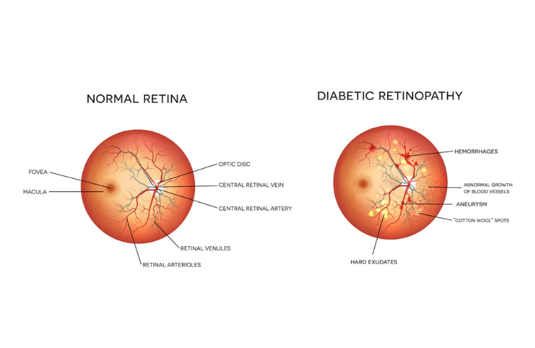 diabetic-retinopathy-min