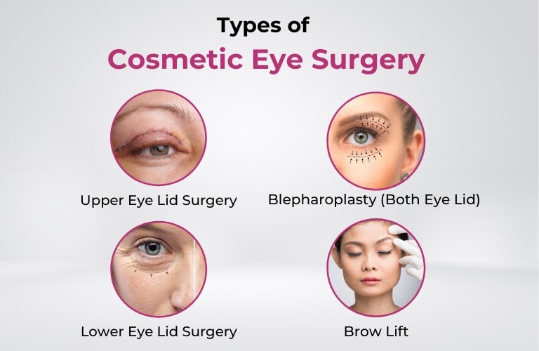 types of cosmetic eye surgery