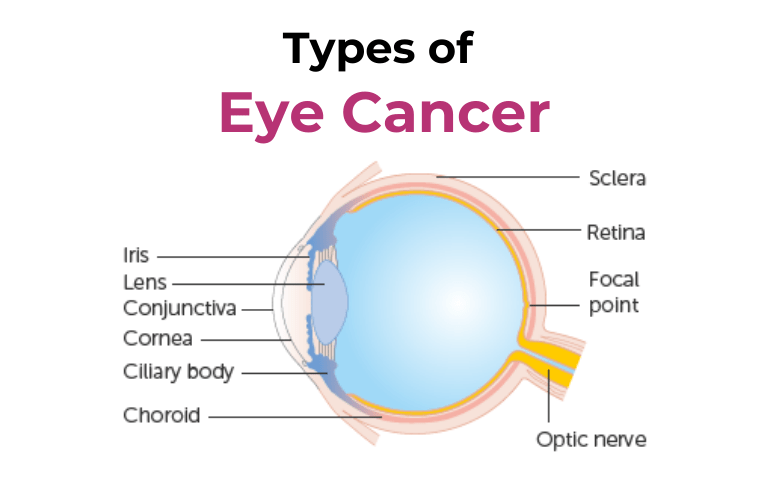 types of eye cancer