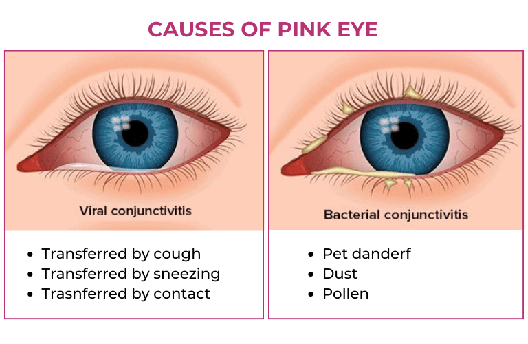 pink-eye-causes